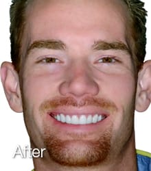 Adam Lumineers after photo.