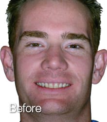 Adam Lumineers before photo.