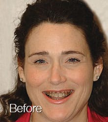 Cecilia Lumineers before photo.