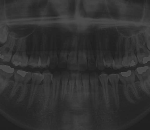 Panoramic X-Ray
