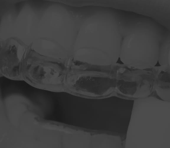 Close up of clear aligner being put into place over teeth